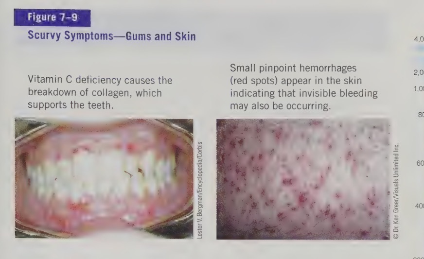<ul><li><p>200 years ago people who went long seagoing ship only had 50% chance of survival because of scurvy. this is due to the cook using fresh veggies and fruits first of the voyage, leaving only grains and animals meats to survive on for the rest of the voyage. once discovered that citrus juice could cure scurvy, british navy required al vessels to provide lime juice to each sailor daily</p></li><li><p>absorbing acid literally means “no scurvy acid”</p></li><li><p>deficiency is now rare. sometimes seen in elderly (if lower food intake), alcohol/drug addicts, and in infants fed not cow’s milk as their fluid (no vitamin c fortified formula or juice. breast milk and formula provide vitamin c</p></li><li><p>Most of the symptoms of scurvy are caused by the breakdown of collagen in the absence of vitamin C. We can also see anemia develop, because of vitamin C’s role in helping the body use and absorb iron. Vitamin C deficiency causes the breakdown of collagen, which supports the teeth.</p></li></ul><p></p>