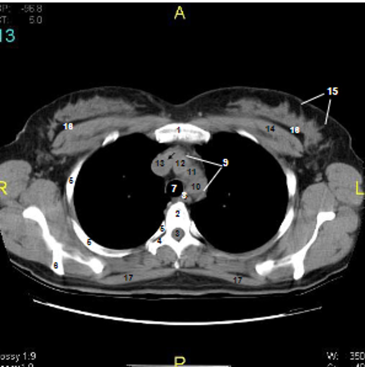 <p>at what number are Cooper's ligaments</p>
