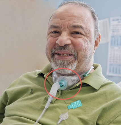 <ol><li><p>Cuff deflation</p></li></ol><ol start="2"><li><p>Patient education (explain what will happen)</p></li></ol><ol start="3"><li><p>Finger occlusion</p></li><li><p>PMV placement</p></li><li><p>Check back pressure after approx. 15-30 secs (difficulty with airflow movement)</p></li><li><p>Replace if tolerated, continued speaking</p></li><li><p>Monitor for about 30 min if tolerated (can wear for a meal)</p></li></ol><p></p>