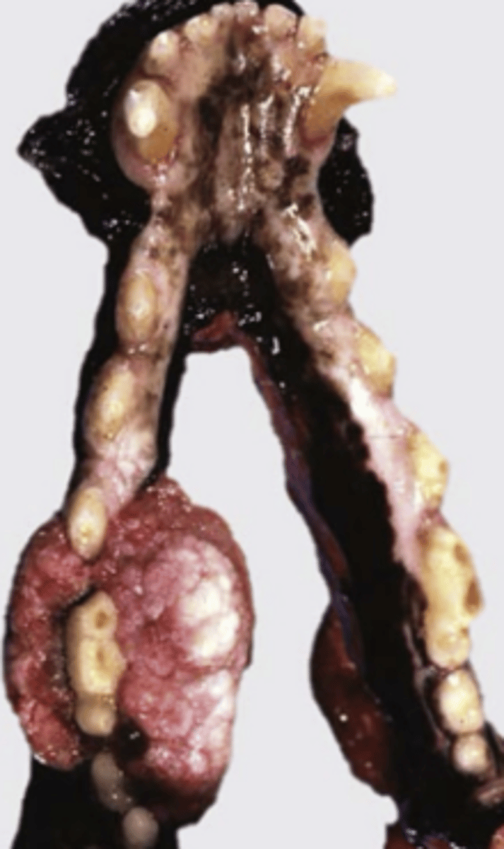 <p>- Benign fibrotic neoplasm (?) of the periodontal ligament that may include entrapped cords of odontogenic epithelium, typically forming one or more nodular lesions</p>