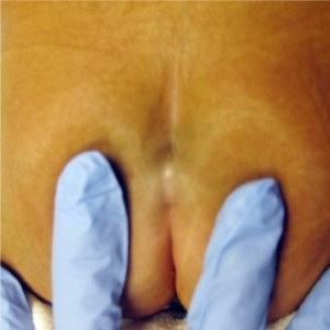 <p>What is the pathology seen here?</p>