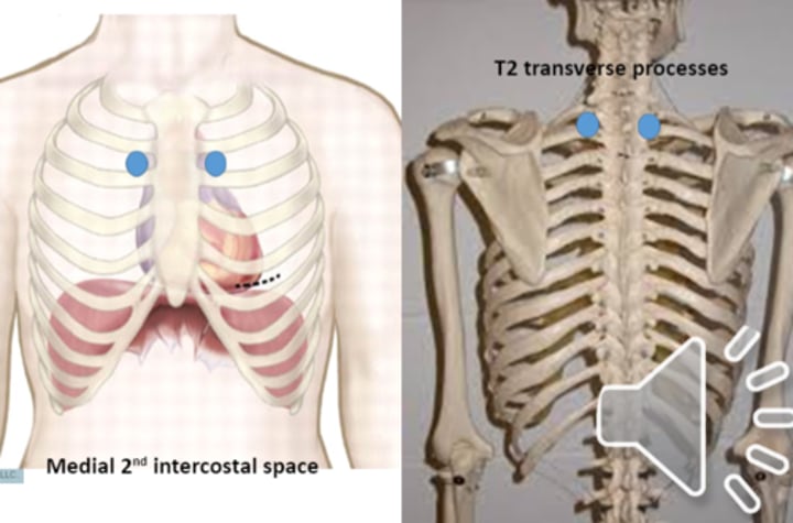 <p>anterior point: medial 2nd intercostal spaces<br>posterior point: T2 transverse processes</p>
