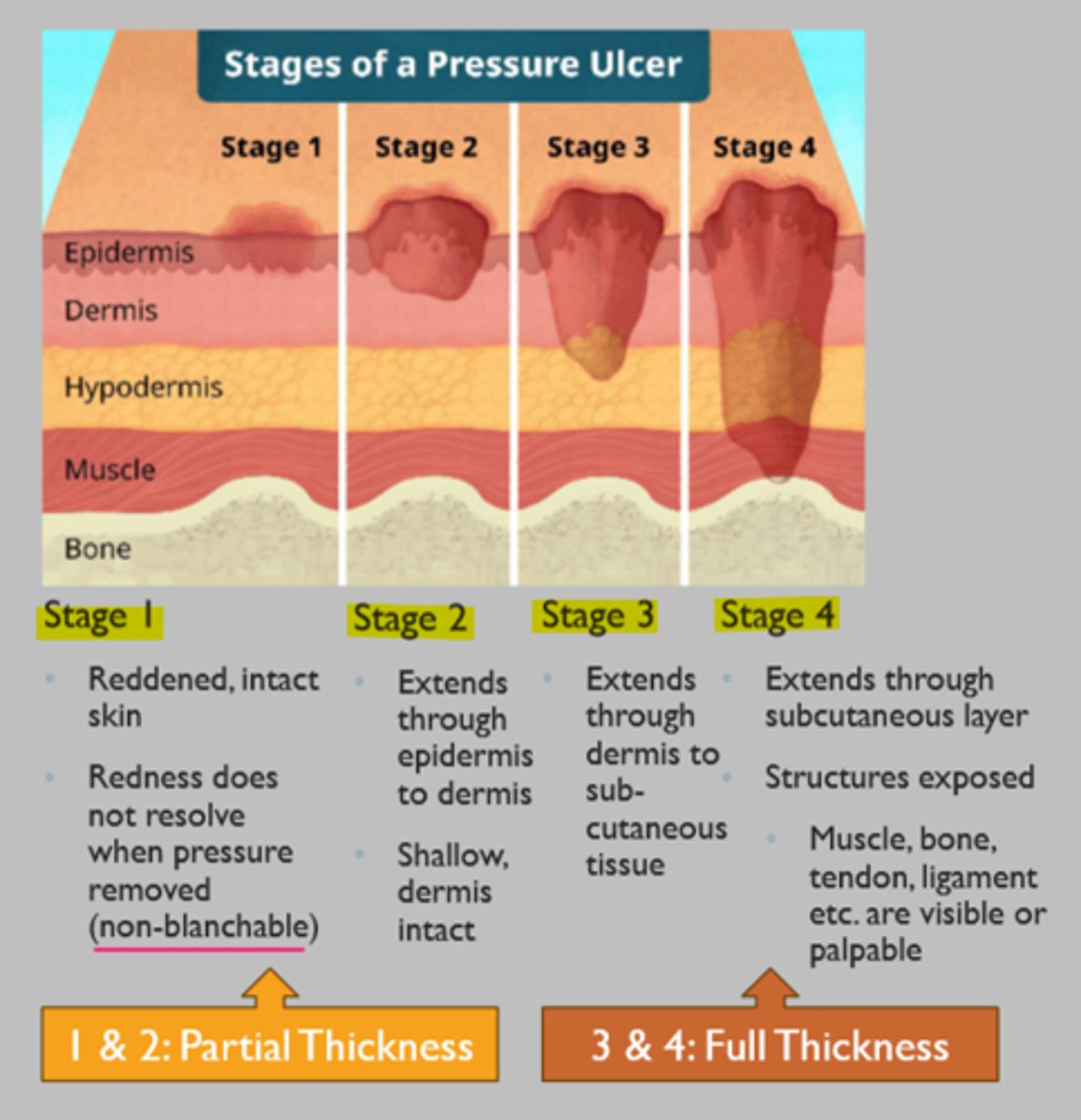 <p>localized area of tissue necrosis that develops when soft tissue is compressed between a bony prominence and an external surface for a prolonged period of time</p><p>high risk areas = any bony prominence</p><p>STAGING RULES:</p><p>- DO NOT reverse stage during documentation of the healing process</p><p>- UNSTAGEABLE if necrotic tissue is covering true depth</p>