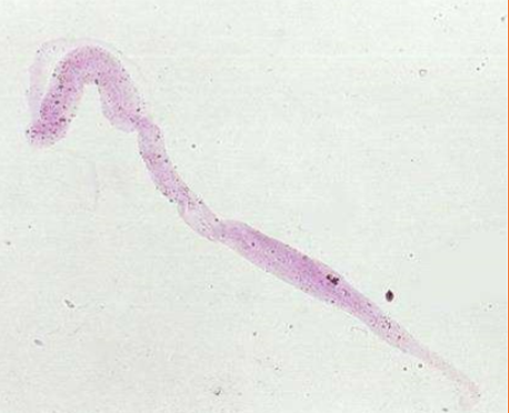 <p>What type of cast is pictured?</p>
