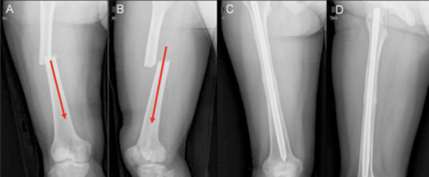 <p>DISTAL!! -- i.e., "deviated medial and anterior"</p>