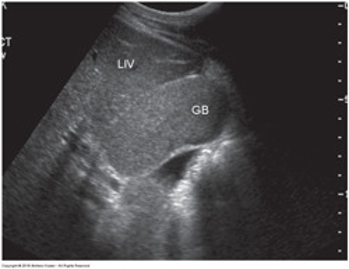 <p>GB may be packed with sludge and difficult to distinguish from liver parenchyma because it will appear isoechoic (aka hepatization).</p><p>Prominet GB with amorphous, low-level echoes without posterior shadowing located in the dependent portion of the gallbladder</p><p>Sludge is gravity dependent- will move with change in patient position</p>
