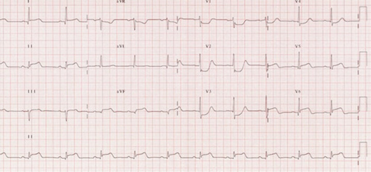 <p>Posterior STEMI</p>