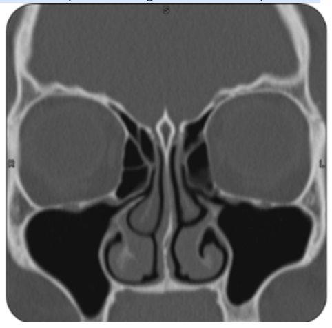 <p>What is the specific findings in the CT scan pictured?</p><p>A. Sinusitis</p><p>B. Tumor</p><p>C. Normal pns ct scan</p><p>D. Post op surgical defect</p>