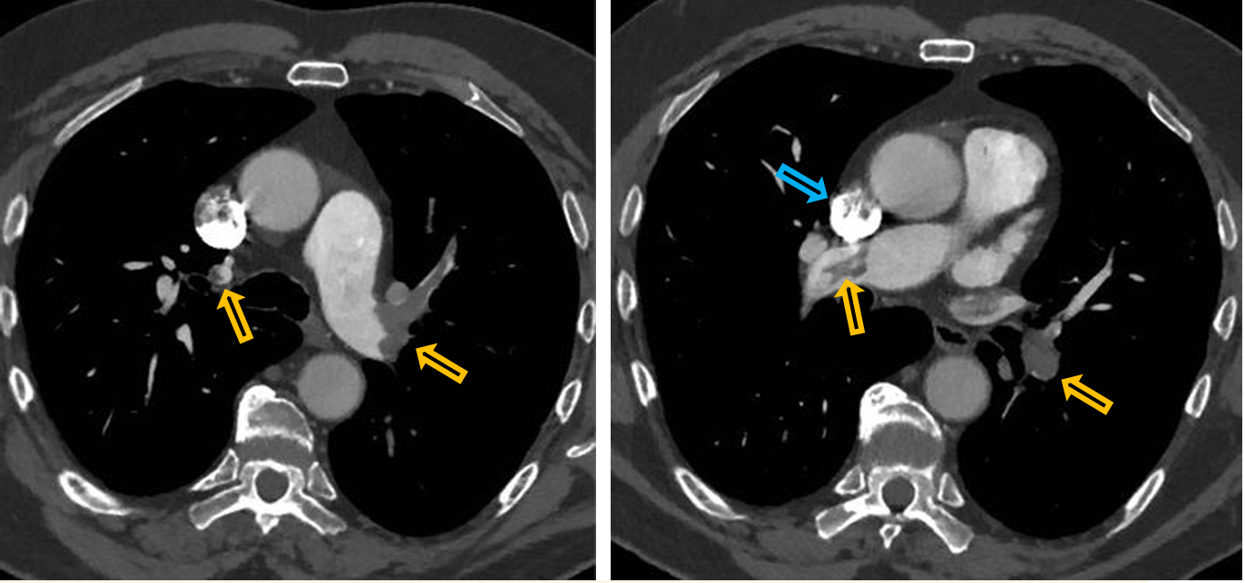 <p>Patient history: elevated D-dimer, dyspnoe and heart palpitations in a female patient after cesarean section </p><p>Modality: Pulmonary CT-angiography, iv. iodine-based contrast agent </p><p>Region: chest, axial views at the level of the pulmonary bifurcation </p><p>Radiologic sign: Large hypodense filling defects in the pulmonary arteries on both sides (yellow arrows). Highest density can be observed in the SVC due to high contrast agent concentration, where it causes artefact (blue arrow). </p><p>Diagnosis: bilateral pulmonary embolism</p>