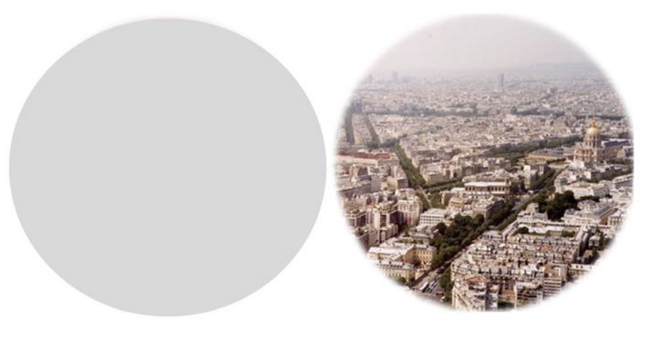 <p><span>Complete blindness in ONE eye</span></p><p><span>damage: Optic nerve (before chiasm); tumor or trauma</span></p>