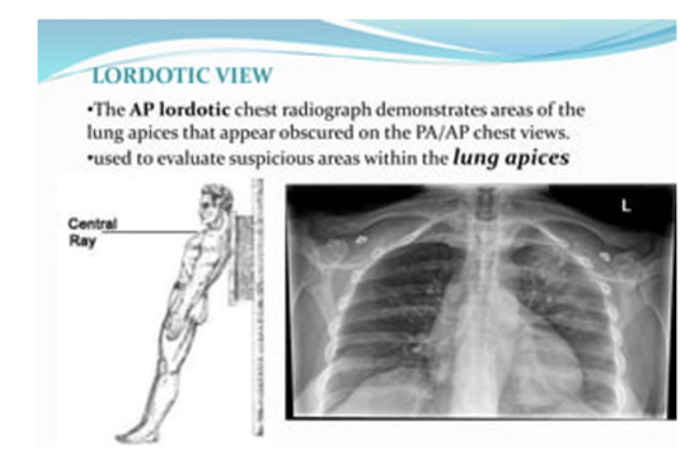 <p>To evaluate suspicious areas within the lung apices</p>