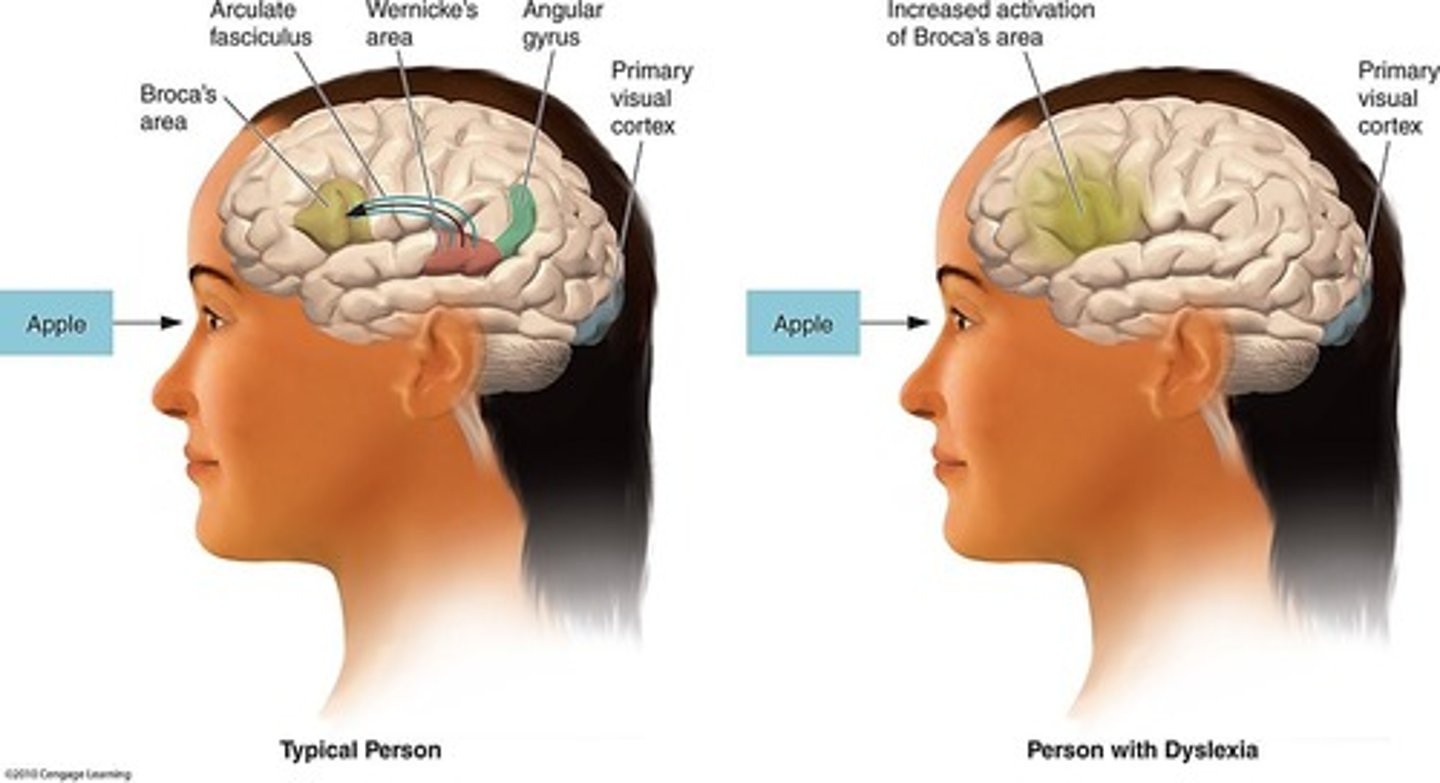 <p>Most common learning disability characterized by difficulty learning to read, with a genetic component and related to asymmetry</p>