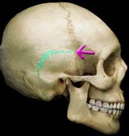 <p>joint between temporal and parietal bone; fuses them together</p>
