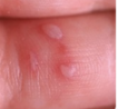 <p>• Hand Foot Mouth Disease</p><p>• Painful, blister-like lesions</p><p>• Redness surrounding</p>