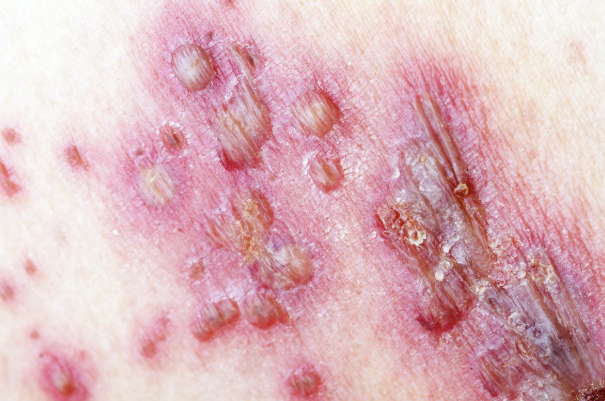 <p>what type of raised, fluid-filled, primary skin lesion is this?</p>