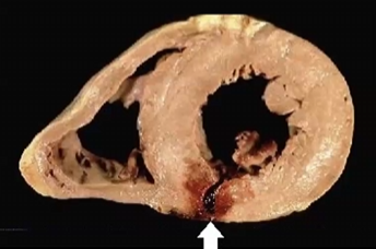 <p>What wall segment is involved in this injury</p>