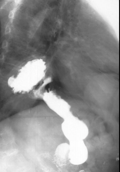 <ul><li><p>barium swallow and UGI will show smooth esophagus and stomach with rugae patterns (roughened structure above diaphragm)</p></li></ul><p></p>