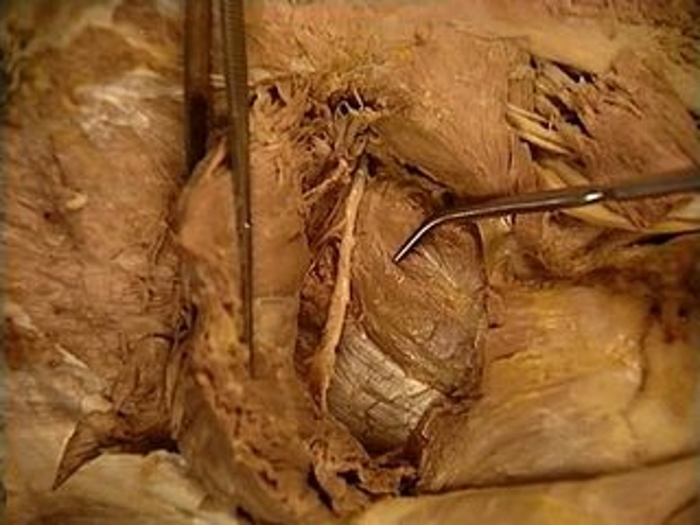 <p>Abducts and medially rotates thigh; External surface of ilium between anterior and inferior gluteal lines</p>