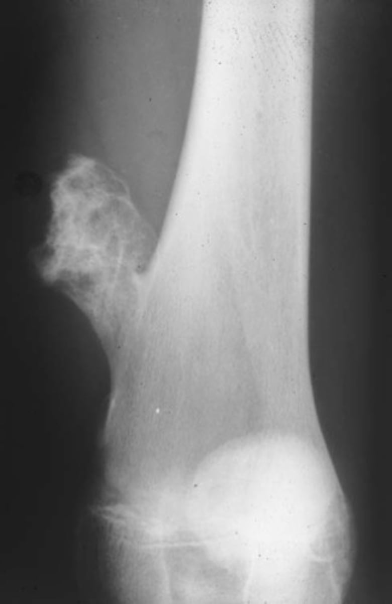 <p>osteochondroma (exostosis)</p>