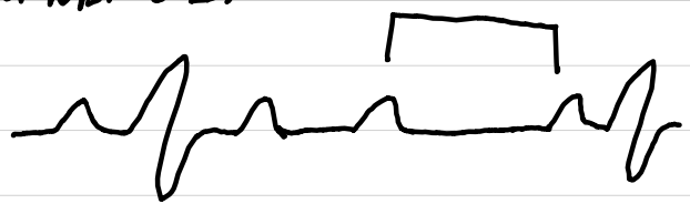 <ul><li><p>rate: any (<span style="color: red;"><span>ventricular < atrial</span></span>)</p></li><li><p>rhythm: atrial regular, <span style="color: red;"><span>ventricular regular/irregular</span></span></p></li><li><p>P waves: normal</p></li><li><p>PR interval<span>: normal or </span><span style="color: red;"><span>prolonged</span></span></p></li><li><p>QRS complexes: <0.10 sec or <span style="color: red;"><span>absent</span></span></p></li><li><p>ST segments: normal</p></li></ul><p></p>