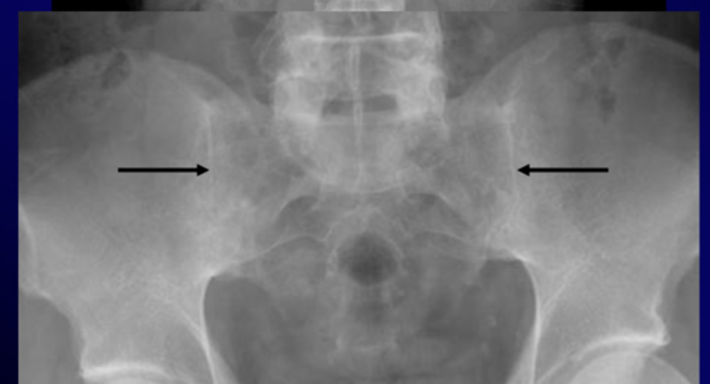 <p>chronic and progressive arthritis characterized by inflammation and eventual fusion of sacroiliac and spinal facet joints, involvement of paravertebral soft tissues, more common in young males</p><p>xray</p><p>- sacroiliitis: bony fusion or ankylosis of sacrum and ilium</p><p>- bamboo spine: ossification of outer fibers of annulus fibrosis</p>