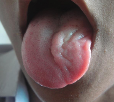 <p>Lesions lead to ipsilateral tongue deviation</p>