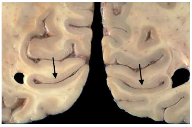 <ul><li><p>massale aankomst van gemyeliniseerde axonen vanuit LGN naar laag IV van primaire visuele cortex (langsheen sulcus calcarinus)</p></li><li><p>parallel aan oppervlakte van cortex, in occipitale kwab</p></li></ul><p>→ streping met blote oog zichtbaar</p><p></p>