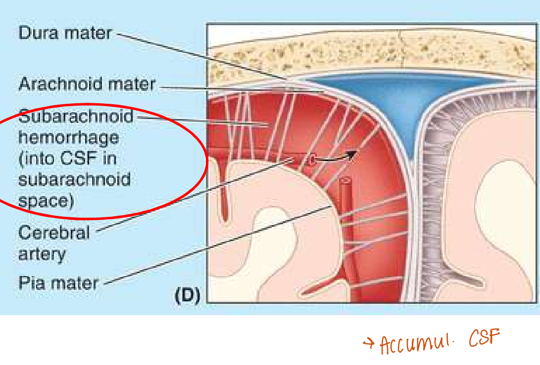 <p>Accumulation de sang entre l’arachnoïde et la pie-mère. Artère cérébral qui se fend </p>