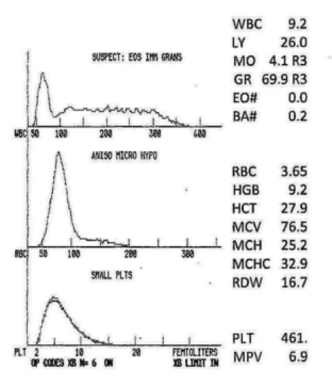 <p>what does the RDW of 16.7 indicate?</p>