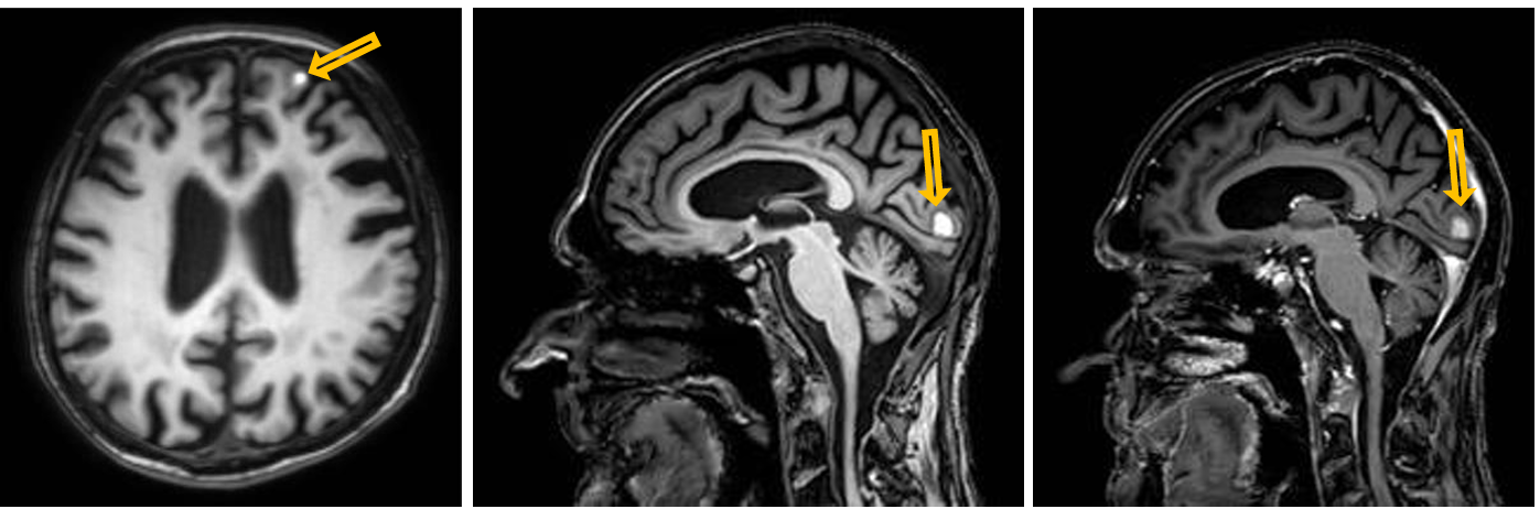 <p>Patient history: melanoma malignum, at present headache and epileptic seizure </p><p>Modality: left image – non-enhanced T1W MRI, axial plane; middle image – non-enhanced T1W MRI, sagittal plane; right image – postcontrast T1W MRI, sagittal plane (iv. gadolinium) </p><p>Region: skull </p><p>Radiologic signs: multiple contrast-enhancing, T1 hyperintense intra-axial space-occupying lesions in the left frontal and occipital lobes (yellow arrows) </p><p>Diagnosis: multiple brain metastases from malignant melanoma</p>