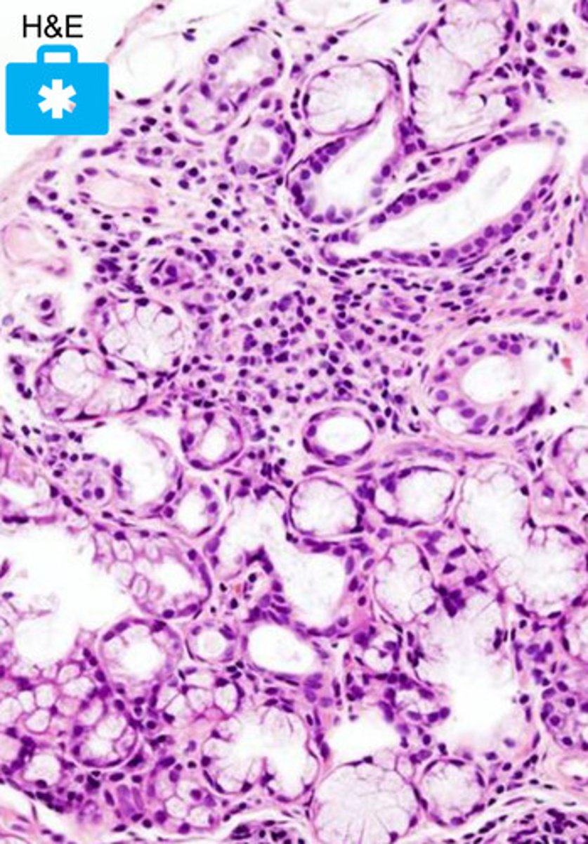 <p>Sjogren's syndrome</p>