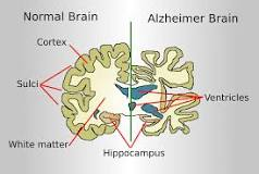 <p>Alzheimers</p>