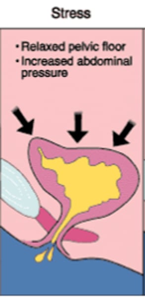 <p>The loss or leaking of urine during increased abdominal pressure from things such as exercise, sneezing, laughing, coughing, or when lifting something heavy.<br>- due to weak pelvic floor muscles, common postpartum</p>