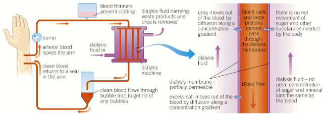 <ul><li><p>A patient’s blood (containing a blood thinner preventing clots) passes through a <strong>dialysis machine</strong></p></li><li><p>Here it is filtered through <strong>partially permeable membranes</strong> into a <strong>dialysis fluid</strong> in a <strong>countercurrent</strong> system</p></li><li><p>This fluid has the <strong>same</strong> concentration of <strong>glucose </strong>as the patient’s blood, a <strong>typical</strong> concentration of <strong>mineral ions</strong>, and <strong>no</strong> <strong>urea</strong></p></li><li><p>This means that all the urea is filtered out by diffusion, some mineral ions are filtered out to restore the electrolyte balance, and no glucose is lost</p></li></ul><p></p>