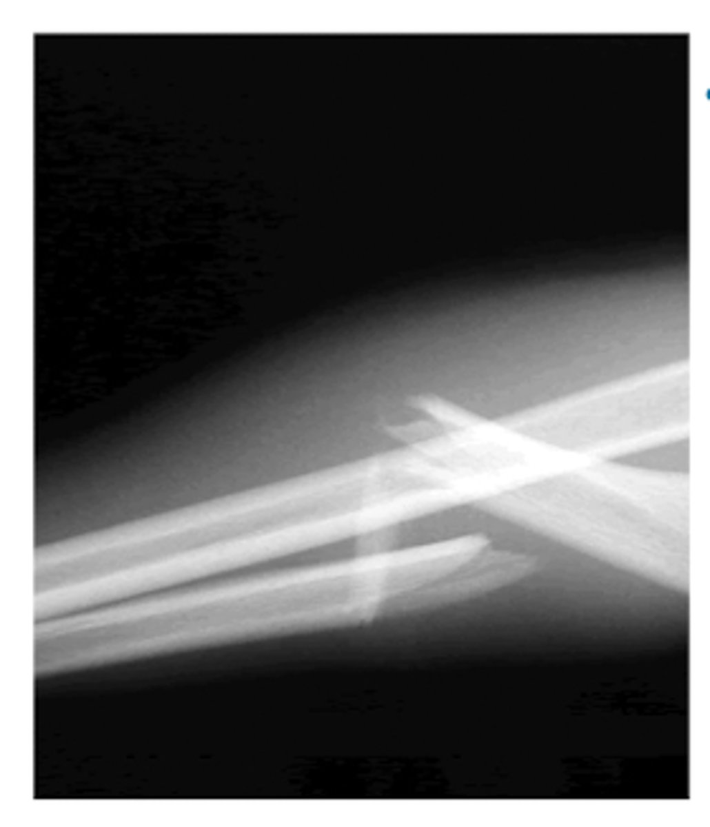 <p>Bado Type I</p><p>- fracture of the proximal 1/3 ulna </p><p>- anterior dislocation of radius</p>