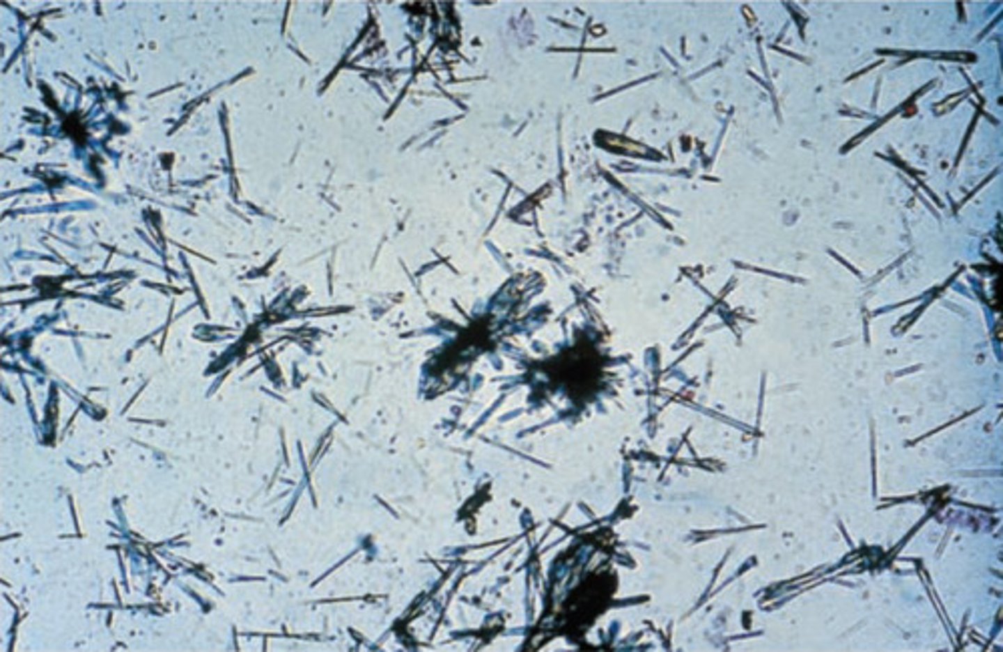 <p>- Acid/Neutral pH</p><p>- Colorless, needles</p><p>- Infection treatment (antibiotics)</p>