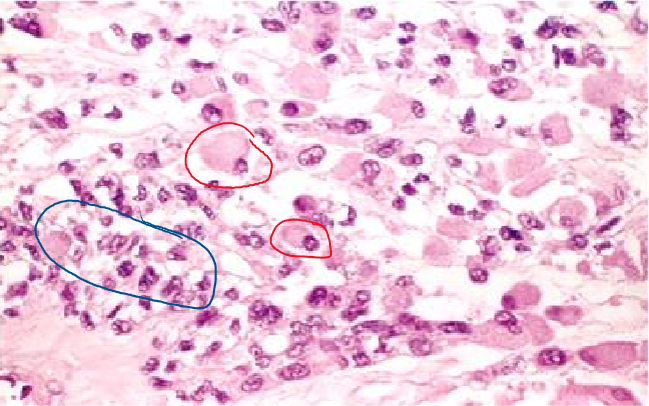 <p>most common soft tissue sarcoma in <strong><mark data-color="green">children &amp; adolescents (alveolar &amp; embryonal)</mark></strong> that often arise in the <strong><span style="color: red">sinuses, head, neck, &amp; genitourinary tract</span></strong></p><ul><li><p><strong>only 20 - 25% arise in skeletal muscles</strong></p></li><li><p><strong><mark data-color="blue">desmin &amp; myoglobin usually present in all types</mark></strong></p><ul><li><p><strong><mark data-color="blue">actin ,myosin, &amp; glycogen also seen</mark></strong></p></li></ul></li><li><p>overall <strong><mark data-color="green">average survival ~ 3 - 5 years</mark></strong></p><ul><li><p><strong>~ 20% already have metastases @ diagnosis</strong></p></li><li><p><strong><mark data-color="red">pleomorphic type = worse prognosis</mark></strong><mark data-color="red"> </mark></p></li></ul></li></ul>