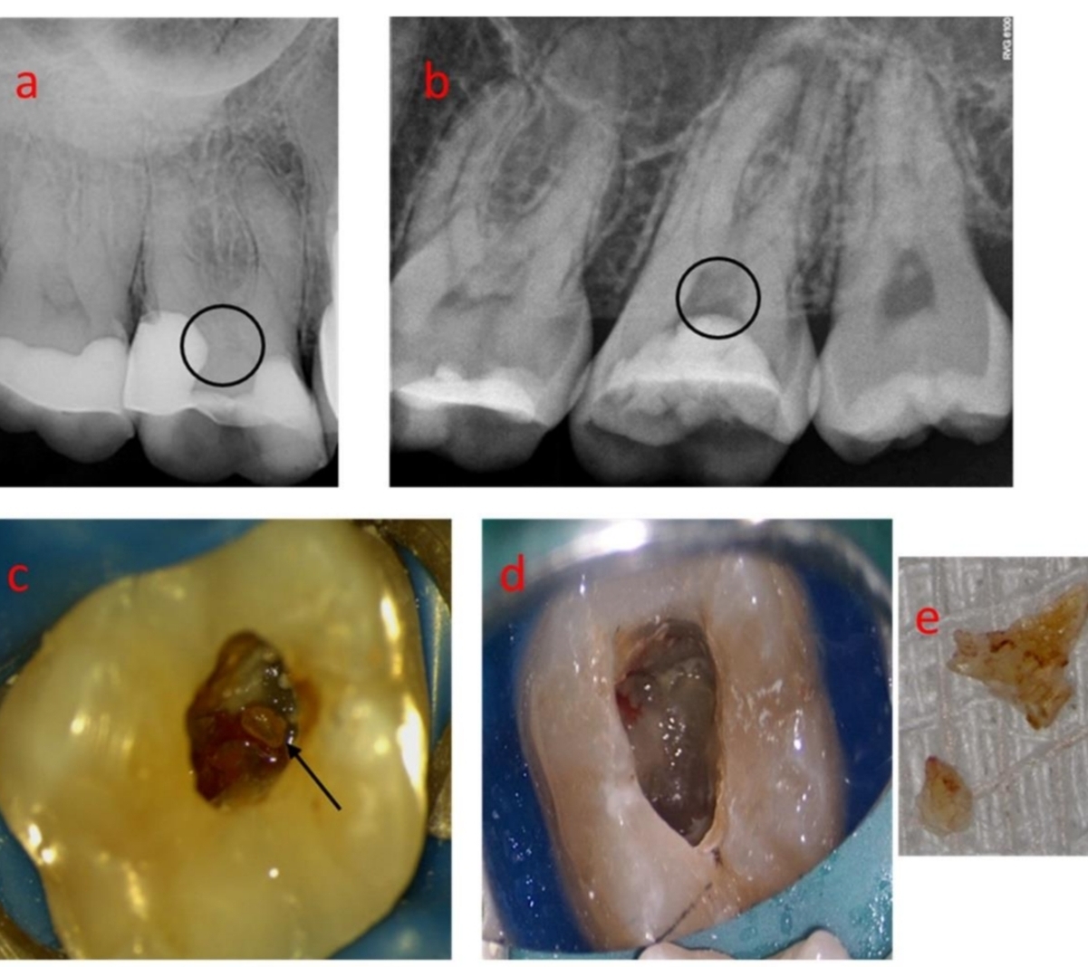 <p>Two most frequent:</p><ul><li><p class="has-focus">One root and canal</p></li><li><p class="has-focus">Pulp stones</p></li></ul><p class="has-focus"></p><p class="has-focus is-empty">other:</p><p class="has-focus">5 roots and 5 canals</p><p class="has-focus">3 MB canals</p>