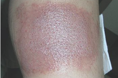 <p><span>ACD presents with <strong>erythematous, pruritic </strong></span><strong>rash</strong><span><strong> </strong>at the site of contact, rash is either linear or geometric</span></p><ul><li><p>ACD lesions are <strong>indurated with distinct borders or edges</strong></p></li><li><p>Develop <strong>vesicles or bullae (&gt;1cm)</strong></p></li><li><p>Patients complain of <strong>burning sensation at site of lesion</strong></p></li></ul><p><strong>Initial rash spreads as papules, vesicles and bullae</strong></p><p></p>