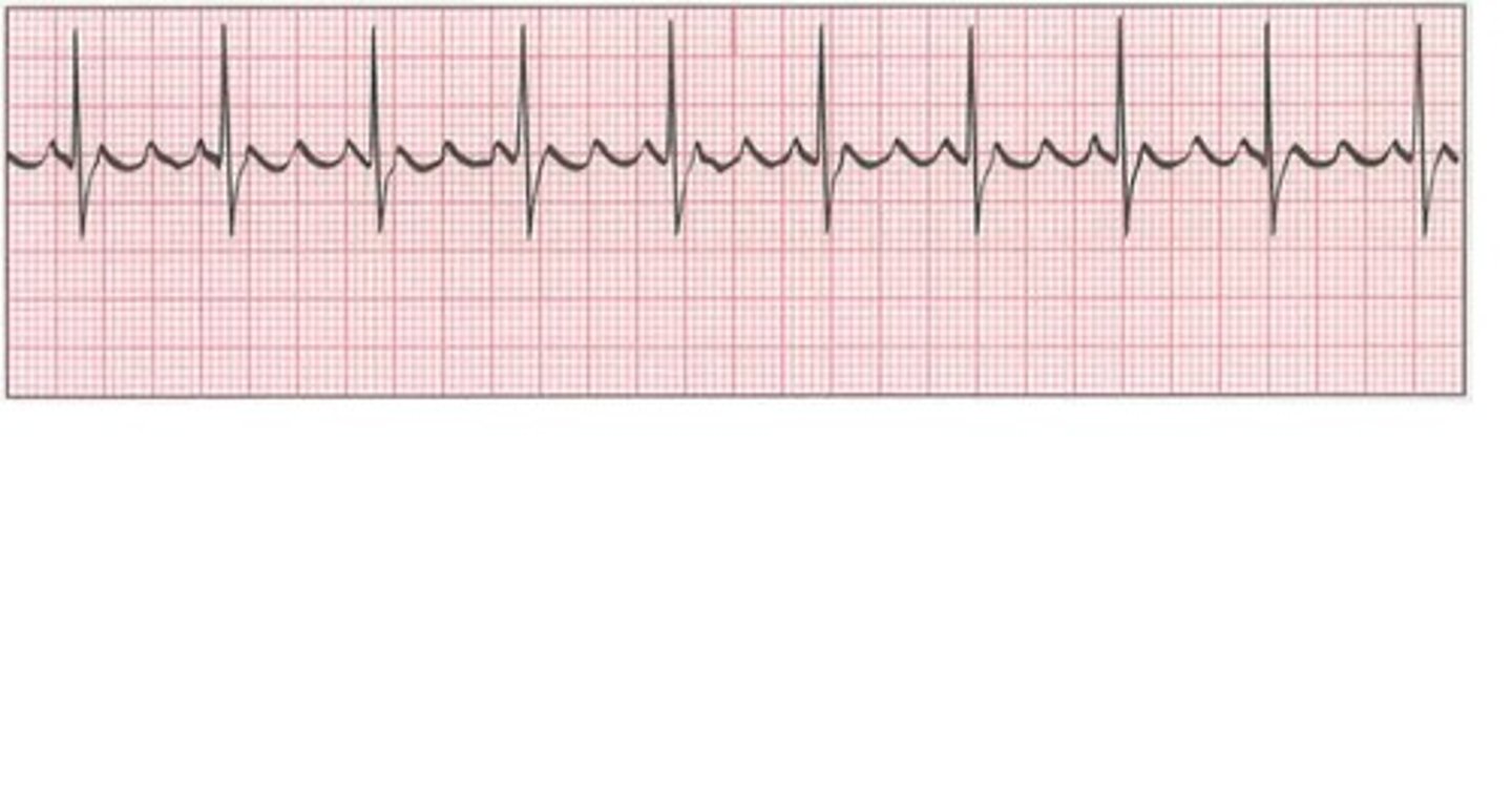<p>atrial flutter</p><p>* often misdiagnosed as SVT</p><p>ventricular rate ≥150 bpm + narrow QRS</p><p>management</p><p>unstable = cardiovert</p><p>stable - same as AF, rate vs rhythm control</p>