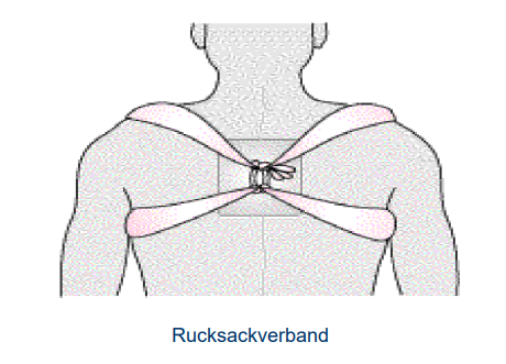 <ul><li><p>auch konservative Therapie möglich</p><ul><li><p>gute Ausheilung</p></li></ul></li><li><p>Ziel Rucksackverband → Aufrechte Position → Druck aufs Schlüsselbein → durch anatomische Haltung kommt es zur Abheilung</p><ul><li><p>unangenehm &amp; unpraktisch</p></li></ul></li></ul><p></p>