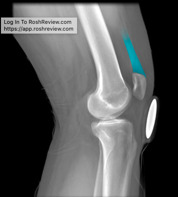 Action:
Extension of leg
Flexion of thigh at hip joint (rectus femoris only)

Innervation:
Femoral nerve