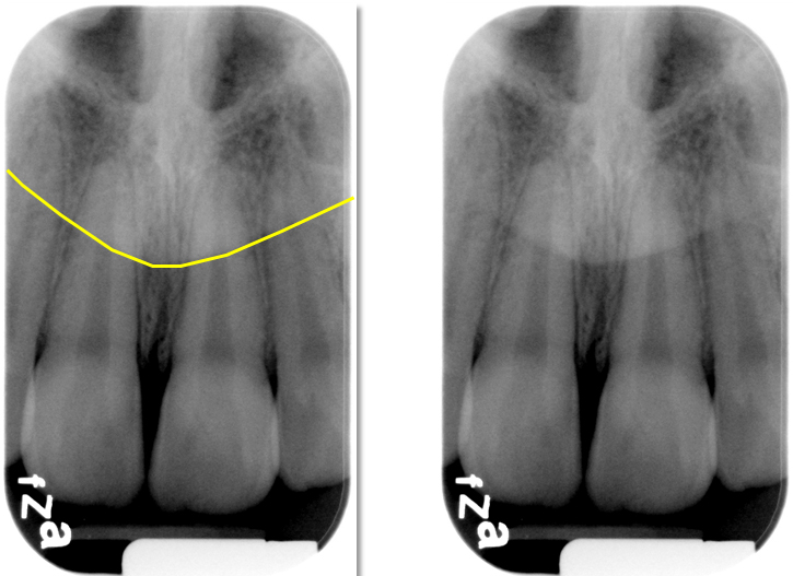 <p>On a radiograph, soft tissue (like the nose, lips, tongue) appears as a faint, lighter gray shadow—less radiopaque than bone/teeth, but more radiopaque than air.</p><p>Example: the nose shows as a soft-tissue outline or shadow overlying the anterior maxilla, without distinct internal detail.</p>