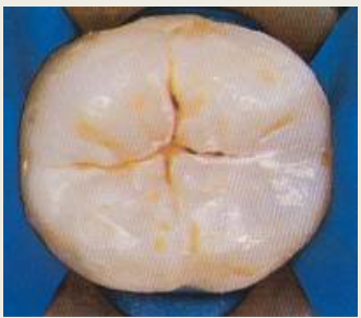 <p>Fine depressed lines in the enamel of a tooth that mark the union of the lobes of the crown.</p>