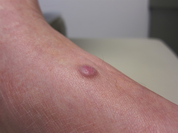 <p>firm, hyperpigmented nodule , lower extremities, fibrous component with dimpling in center when pinched. Dx. </p>