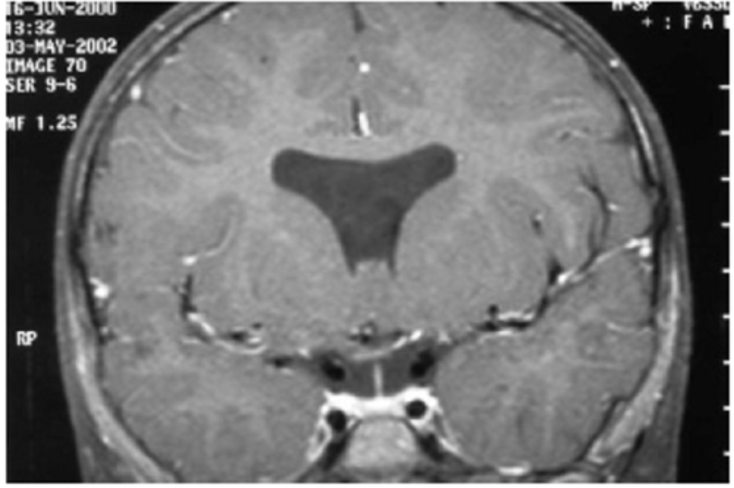<p>septo-optic dysplasia with...</p><p>bilateral ONH dyplasia</p><p>absence of septum pellucidum</p><p>agenesis of corpus callosum</p><p>dysplasia of 3rd ventricle</p><p>hypopitutitarism</p>