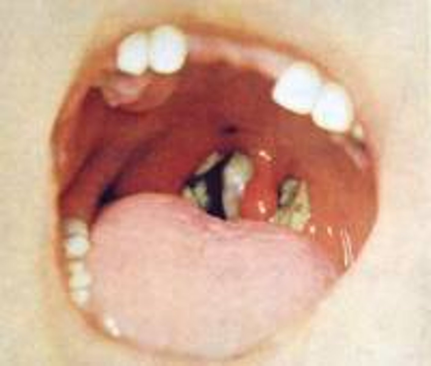 <p>- tenacious gray membrane covering the tonsils &amp; pharynx which bleeds w/ scraping</p><p>- sore throat</p><p>- fever</p><p>- malaise</p><p>- cervical lymphadenopathy</p><p>- low grade fever</p>