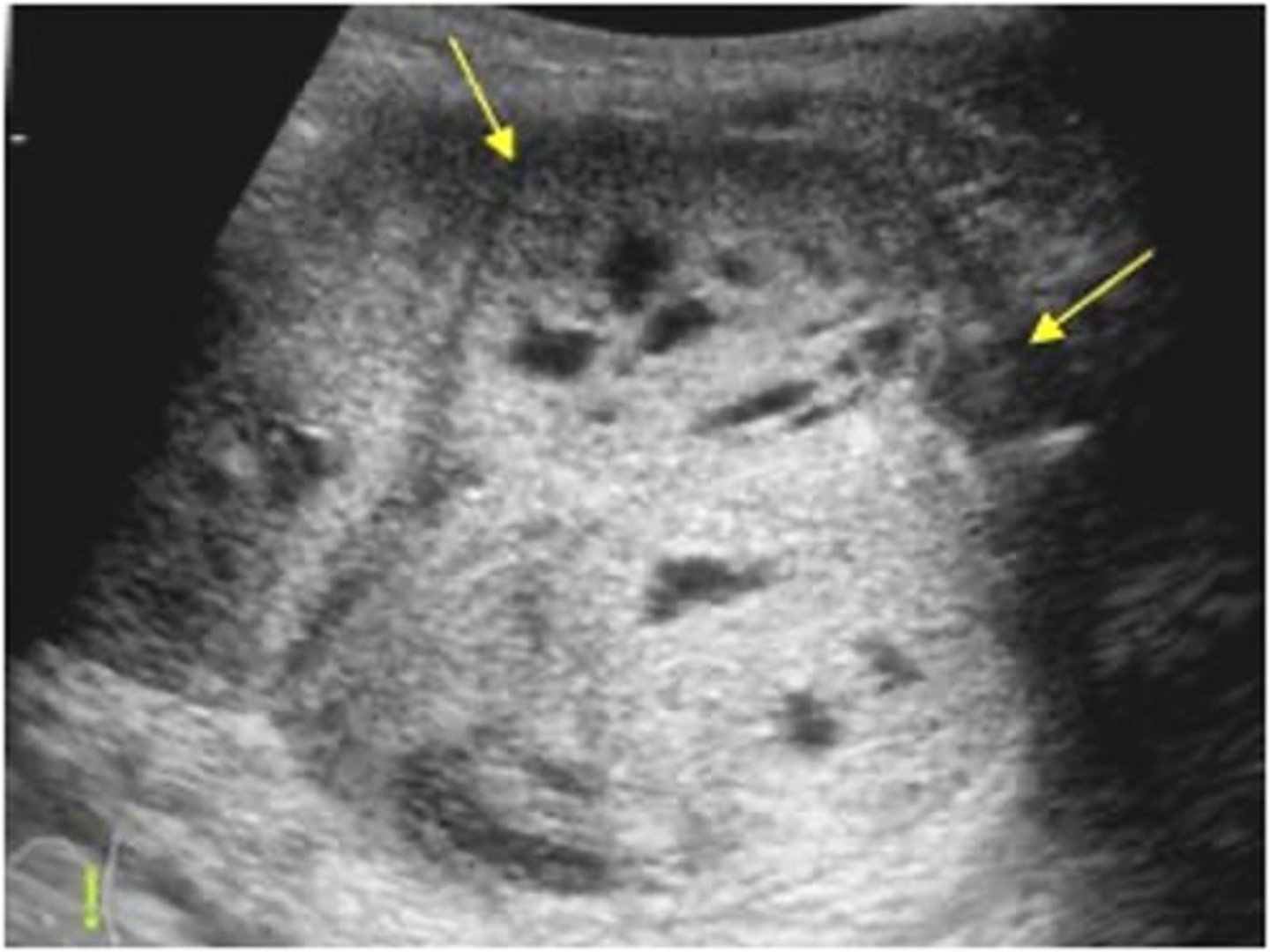 <p>Nephroblastoma is typically found in children ages ___ </p>