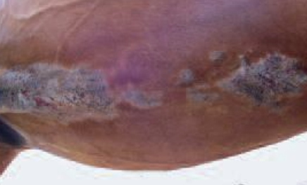 <p>What type of reaction is seen due to insect bites, and is also known as sweet, summer, or Queensland itch? It is the commonest cause of pruritus and is often in ponies, shire, and Friesian horses. Culicoides midges cause it and it is seasonal.</p>