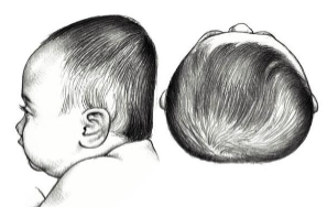 <p>Disproportionate - <strong><em>width</em></strong></p><ul><li><p>bilateral occipital flattening </p></li><li><p>increased cranial width </p></li><li><p>decreased cranial vault height </p></li><li><p>bilateral frontal bossing</p></li></ul><p></p>